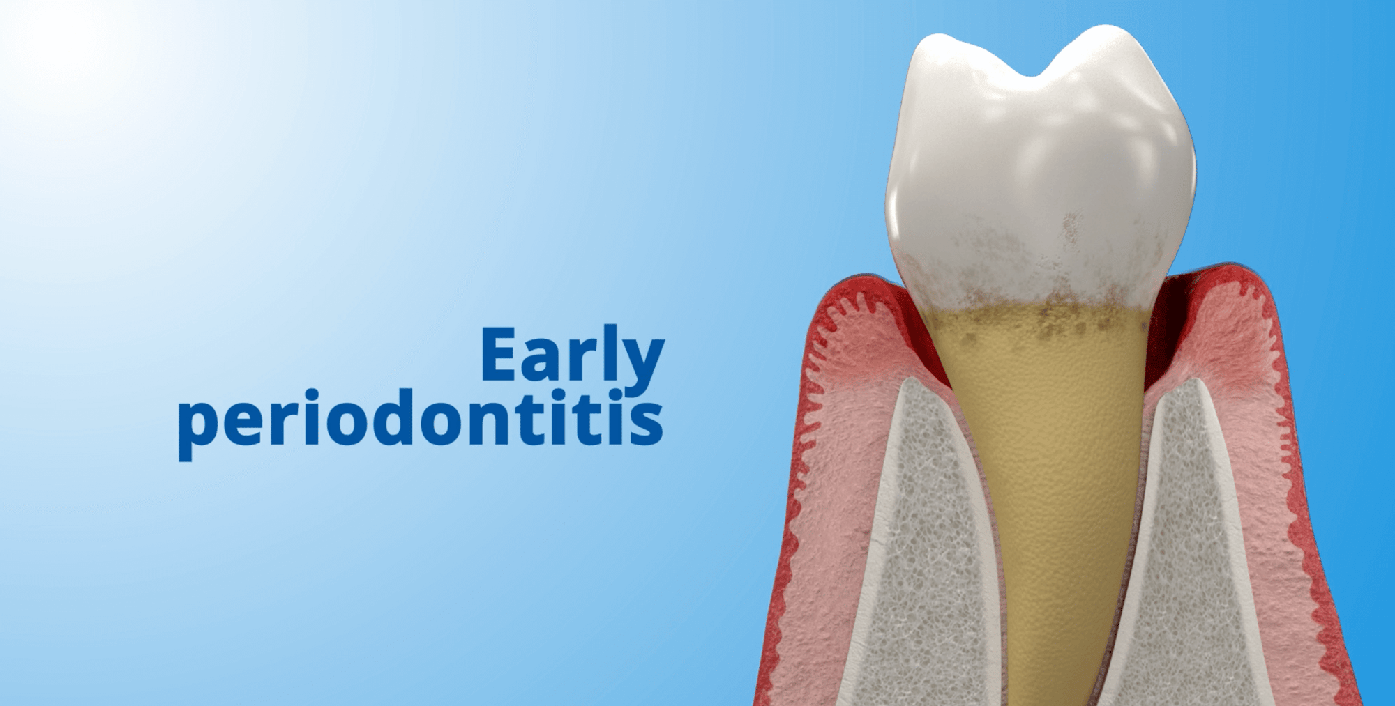 Early Periodontitis