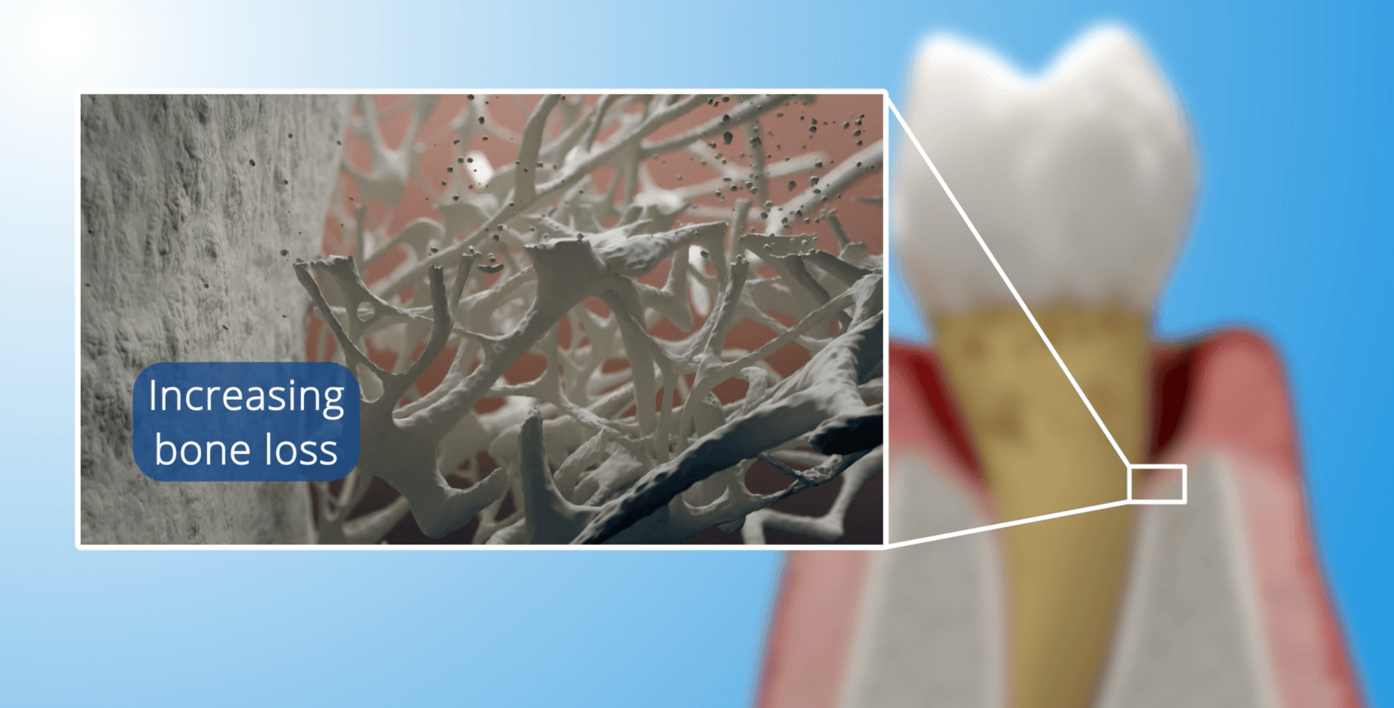 Increasing Bone Loss