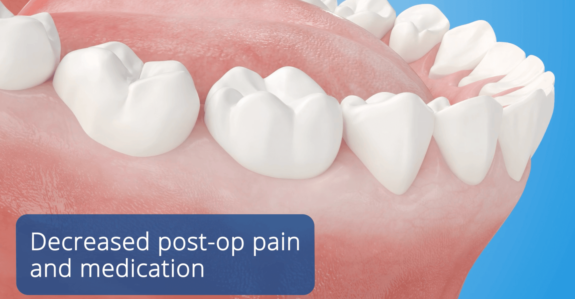 Laser Perio Decreased Post-op pain and medication