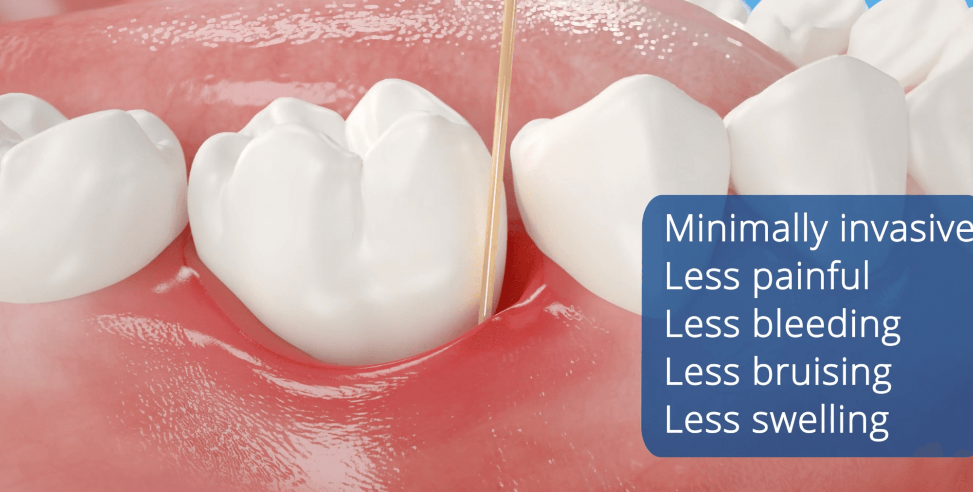 Laser Perio Minimally Invasive Less Painful, less bleeding, less bruising, less swelling