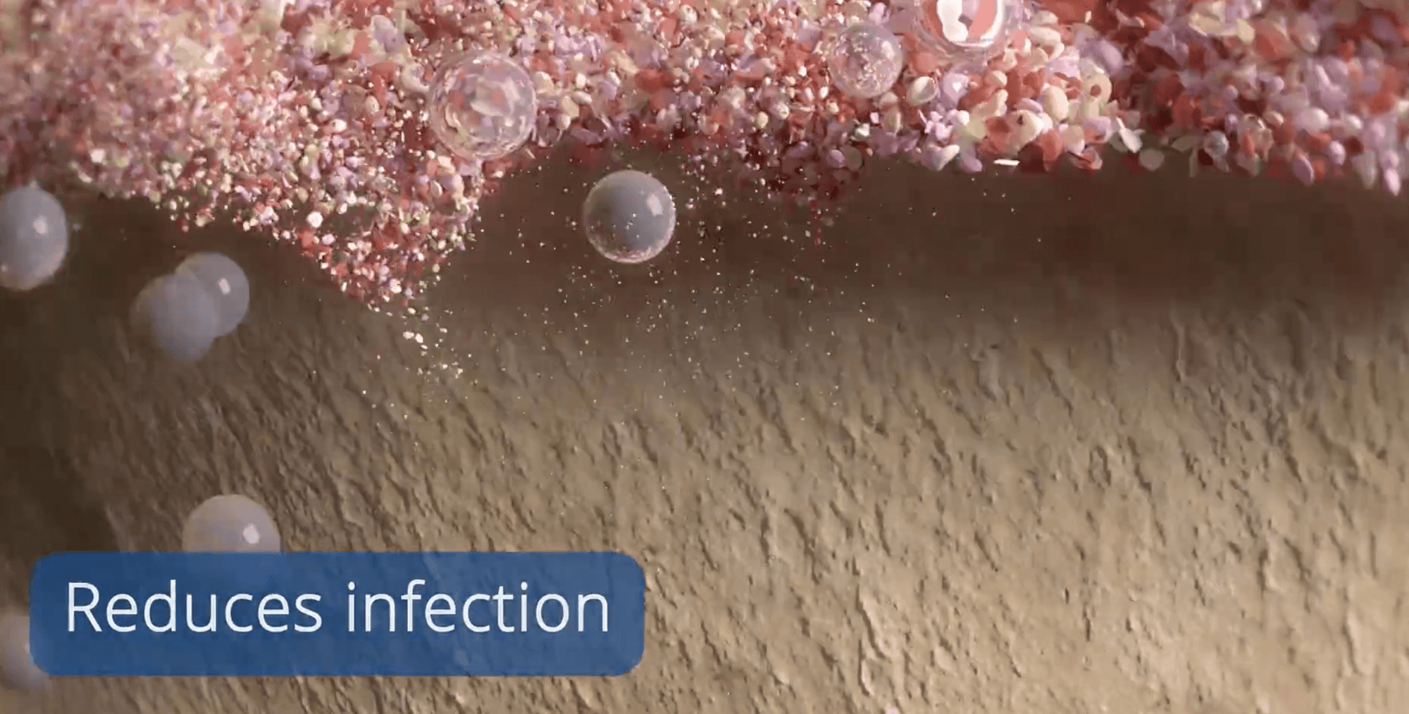 Laser Perio Reduces Infection 2
