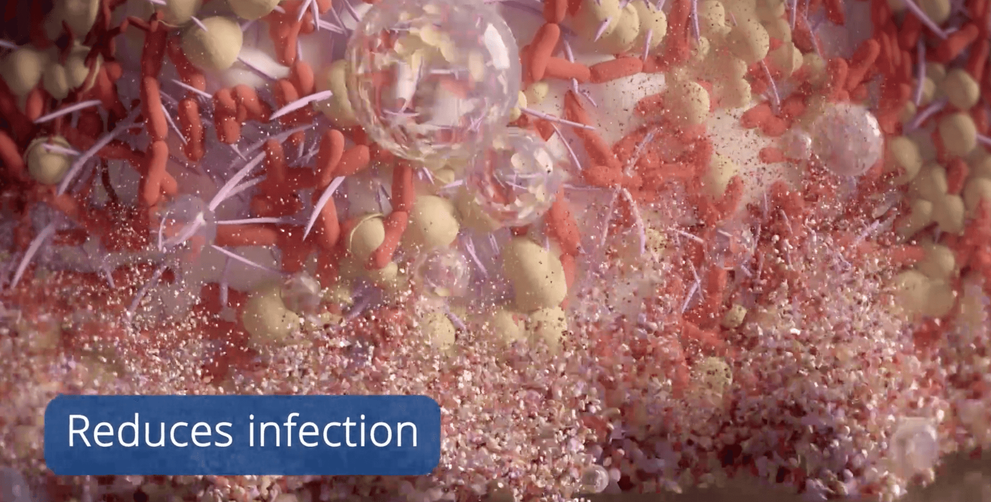 Laser Perio Reduces Infection