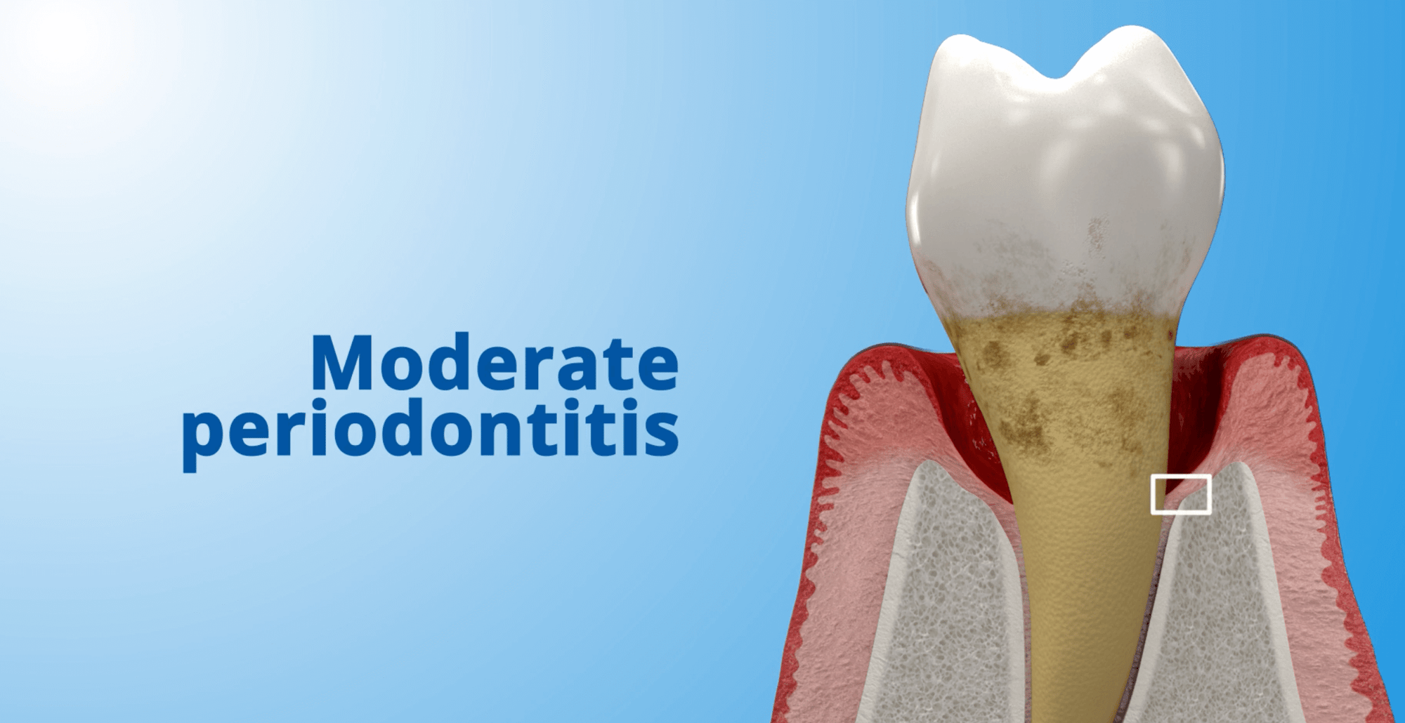 Laser Perio, Moderate Periodontitis