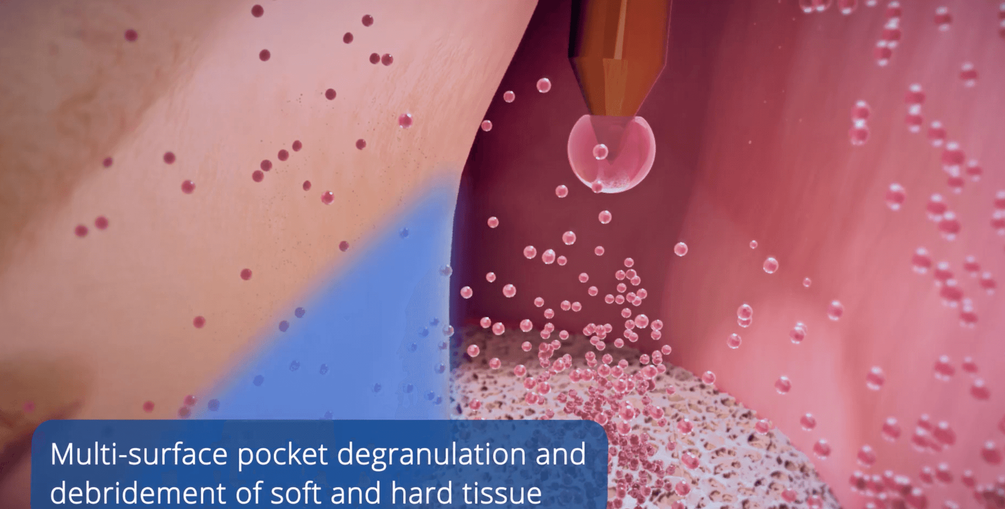 Multi-surface pocket degranulation and debridement of soft and hard tissue