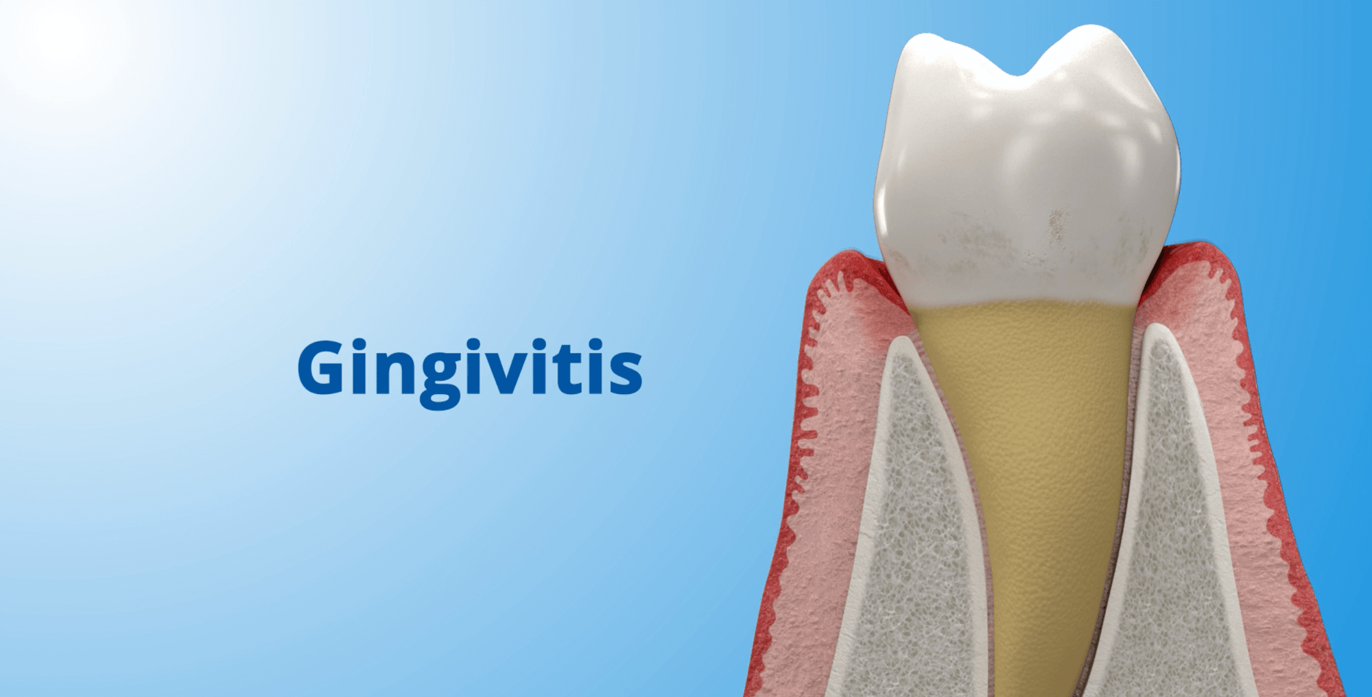 Perio Gingivitis