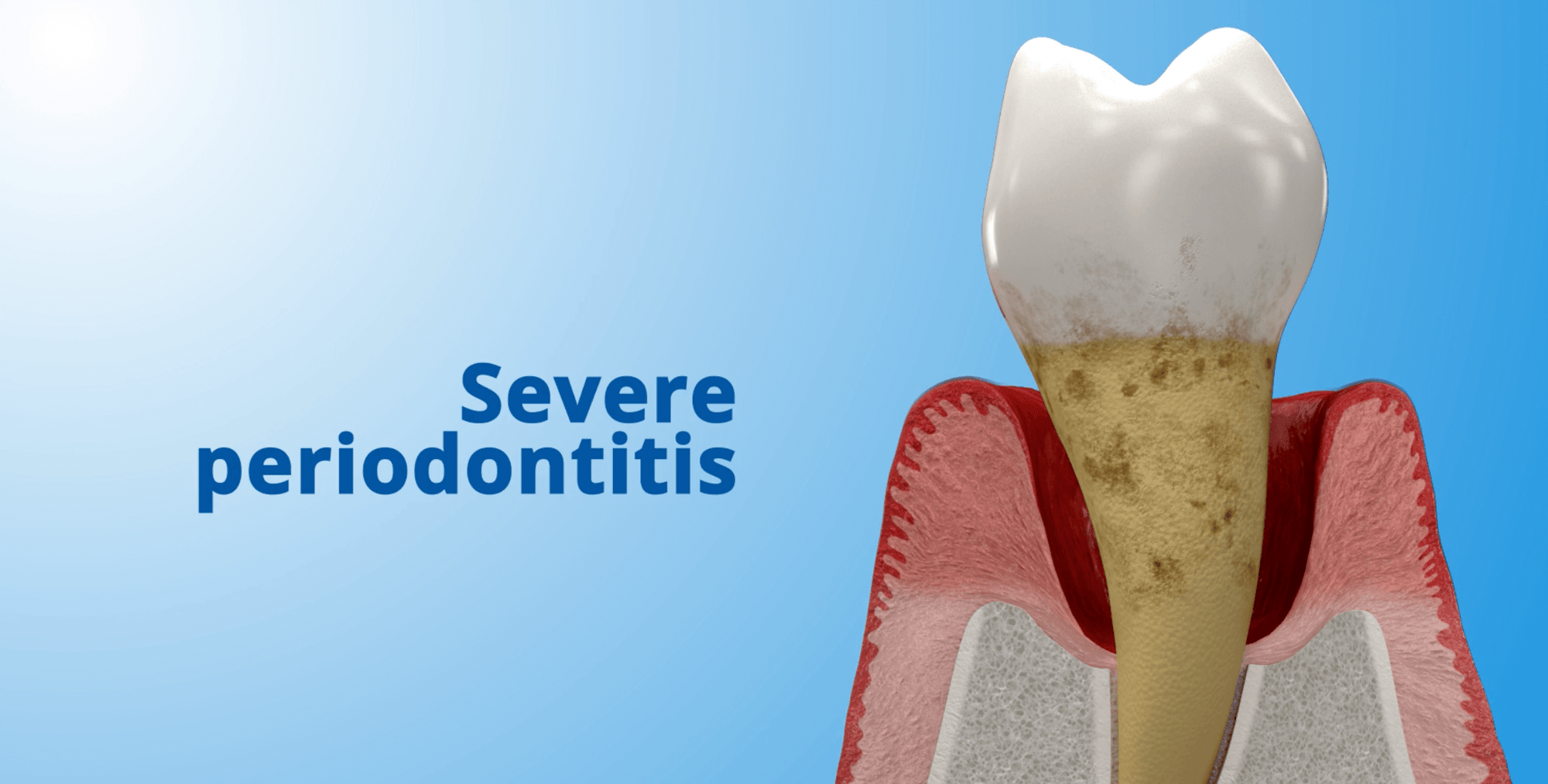 Severe Periodontitis 3