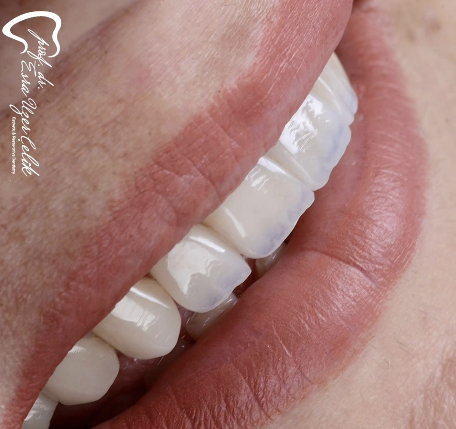 Dr Esra Uzer Celik Direct Composite Veneers Kulzer Dr Esra Uzer Celik Direct Composite Veneers Kulzer