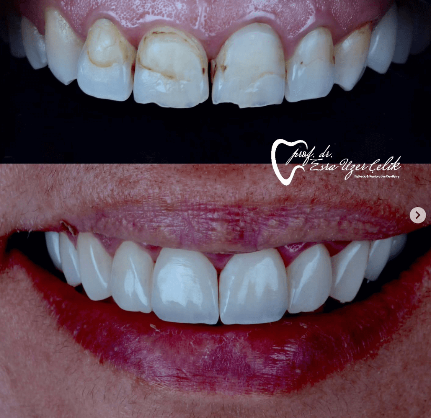 Dr Esra Uzer Celik restorative case Dr Esra Uzer Celik restorative case