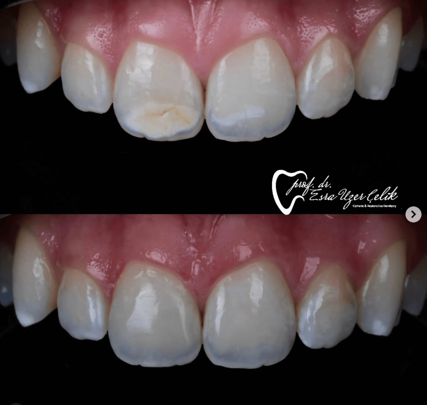 Dr Estra Uzer Celik Direct Composite Restorations Kulzer Charisma Diamondy & Venus Colour Dr Estra Uzer Celik Direct Composite Restorations Kulzer Charisma Diamondy & Venus Colour