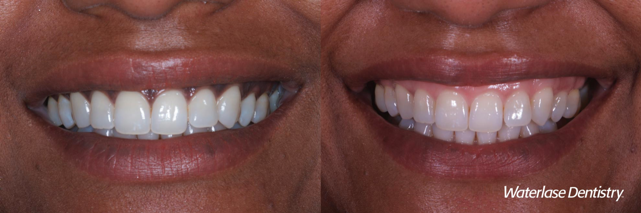 Waterlase Gum Depigmentation biolase